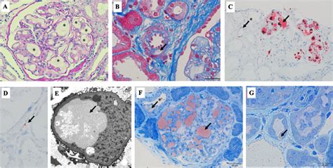 Microscopy Findings Of The Kidney Biopsy A Capillary Lumens Are