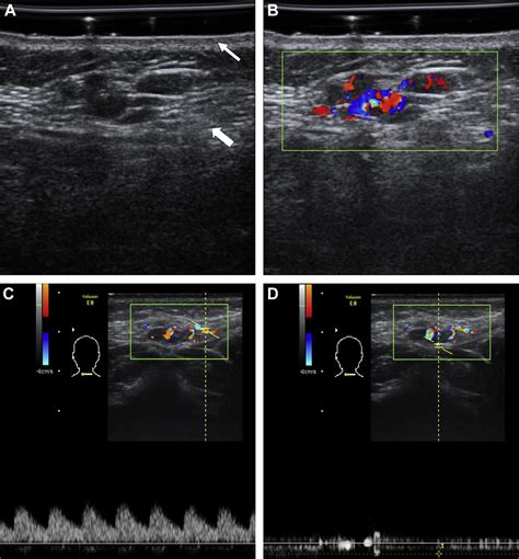 Role Of Ultrasound In Diagnosis And Differential Diagnosis Of Deep