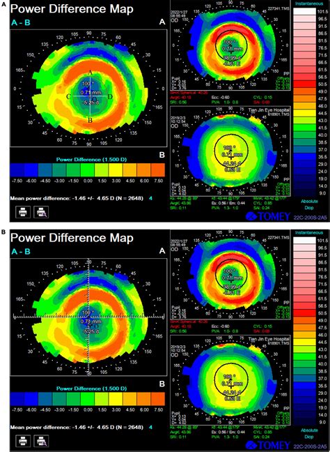 Frontiers Effect Of Treatment Zone Decentration On Axial Length