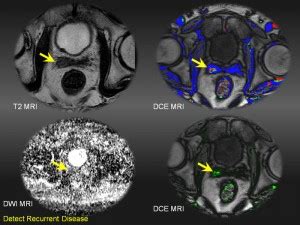 Why a prostate exam with 3T MRI and Computer Aided Detection is best ...