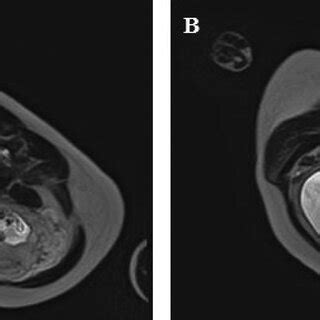 Axial MRI cross-section of the uterus: (A) at the level of the... | Download Scientific Diagram