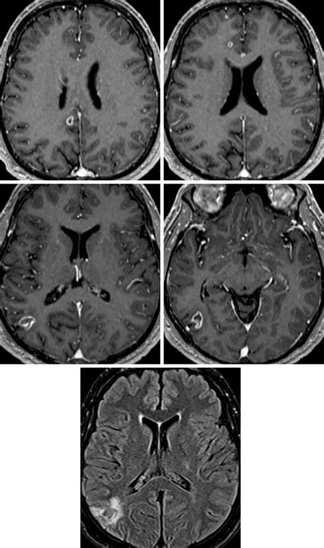 Neurocysticercosis The Neurosurgical Atlas