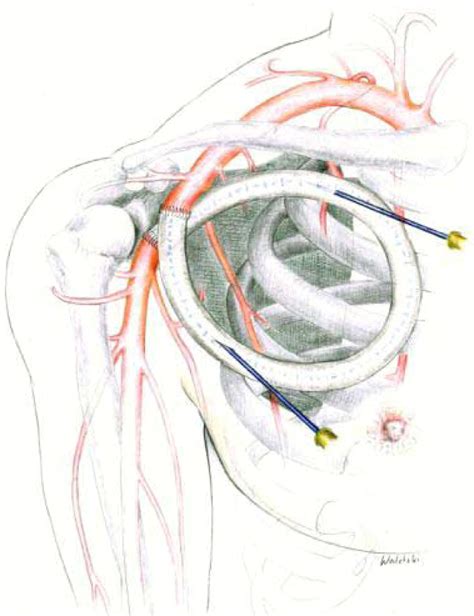 Axillary-axillary interarterial chest loop conduit as an alternative