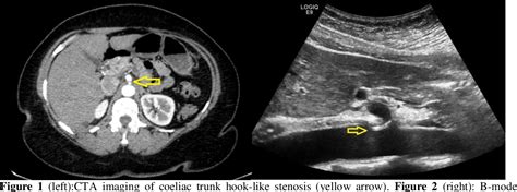 Figure 1 from Median Arcuate Ligament Syndrome Confirmed With Vascular ...