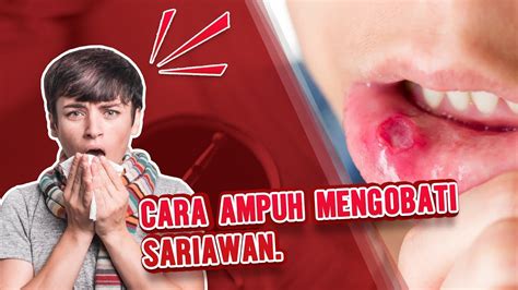 Cara Ampuh Mengobati Sariawan Youtube