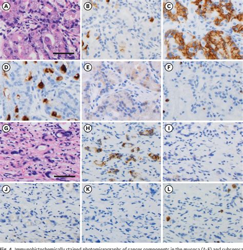 Figure 4 From Gastric Adenocarcinoma Of Fundic Gland Type With