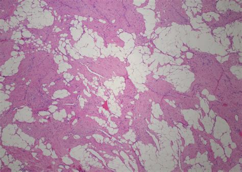 Subcutaneous mass : r/pathology