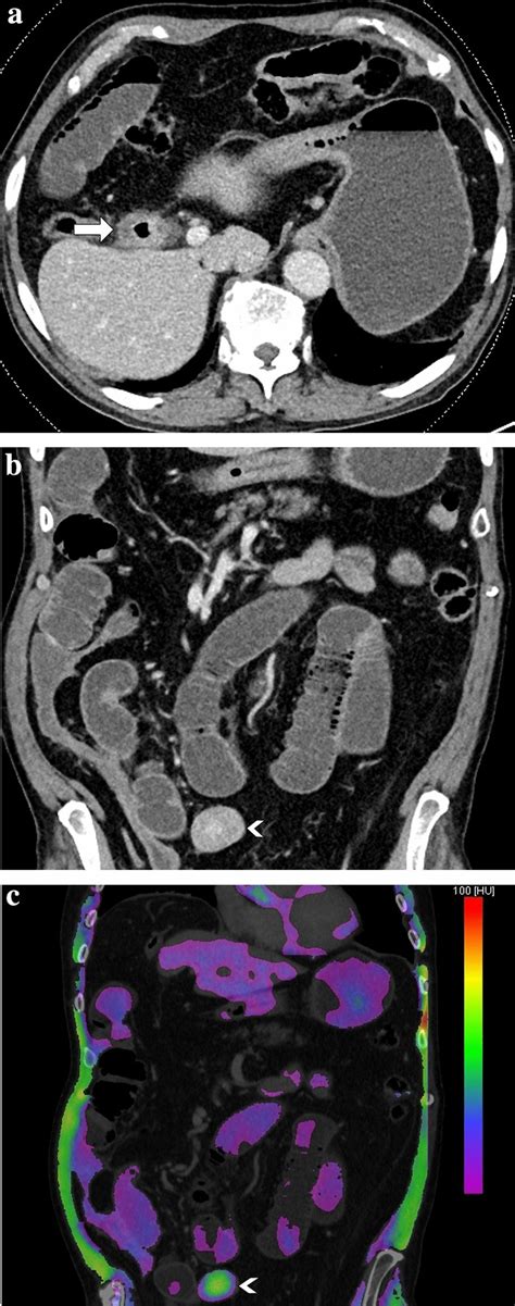 81-year-old man with gallstone ileus. He previously had acute ...