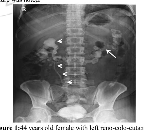 Figure 1 44 From Iatrogenic Reno Colo Cutaneous Fistula In A Case Of