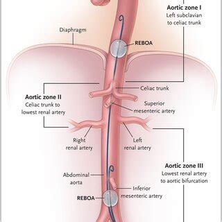 Resuscitative Endovascular Balloon Occlusion Of The Aorta Reboa