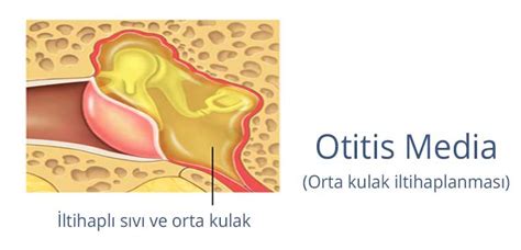 Orta Kulak Iltihab Zel Meltem Hastanesi