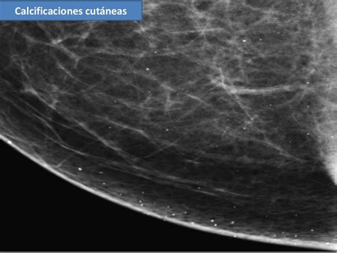 Calcificaciones Mamarias Mamografía