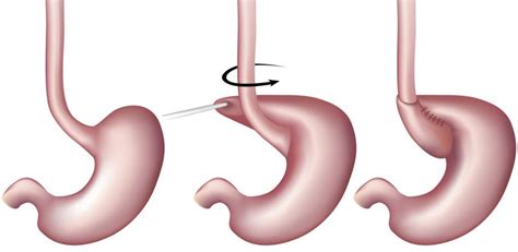 Nissen Fundoplication