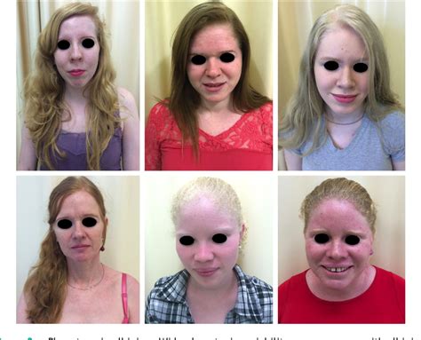 Albinism Epidemiology Genetics Cutaneous Characterization