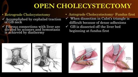 Open cholecystectomy/ operative surgery