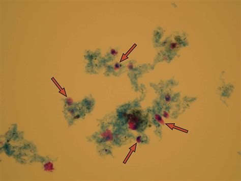 Epithelial Cells In Urine What Does It Mean If You Have Epithelial