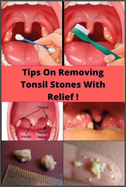 Tips On Removing Tonsil Stones With Relief Herbs Max