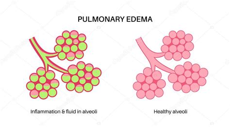 Cartel Anatómico Edema Pulmonar Líquido Anormal Los Pulmones