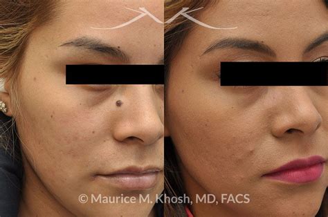 Mole Removal Before And After