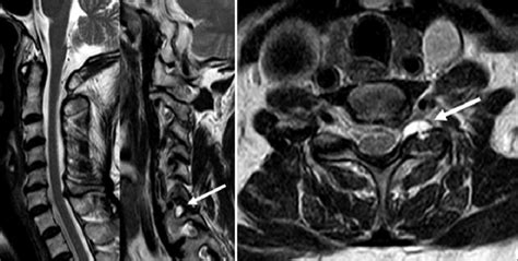 Magnetic Resonance Imaging Scans Showing A T2 Hyperintense Cystic