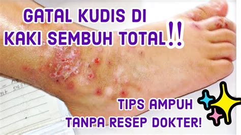 Cara Mengatasi Gatal Gatal Kudis Di Kaki Tanpa Resep Dokter