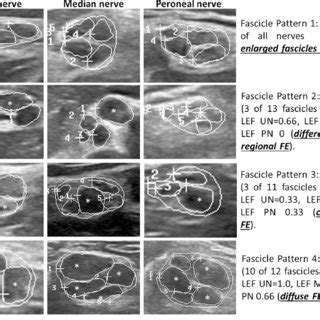 Fascicle Pattern (FP) examples in ulnar, median and peroneal nerve ...