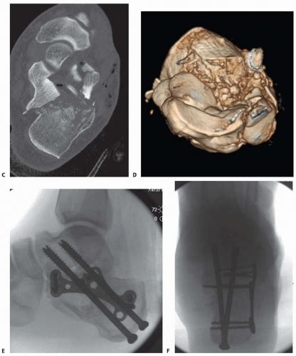 Surgical Treatment Of Calcaneal Fractures Musculoskeletal Key