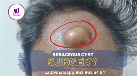 Sebaceous Cyst Removal Sebaceous Cyst Treatment Best Cyst Removal Surgery In Hyderabad Youtube