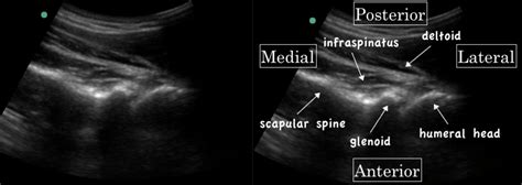 Emergency Medicine Educationem 3am Anterior Shoulder