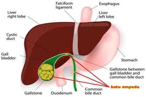 Cara Jitu Cegah Batu Empedu