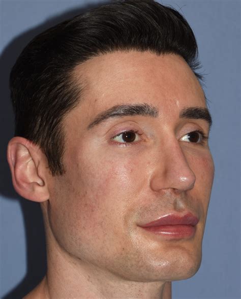 Male High Cheekbone Implants Right Oblique 1 Dr Barry Eppley Explore