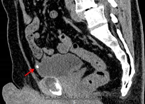 Urachal Cyst