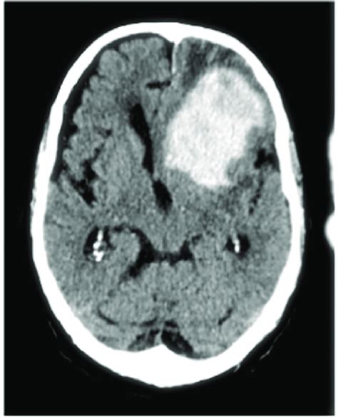 Case 3 CT Scan Of Traumatic Brain Injury With A Left Frontal