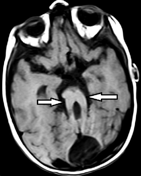 Molar Tooth Sign Transverse T1wi Of Mri Demonstrates Appearance