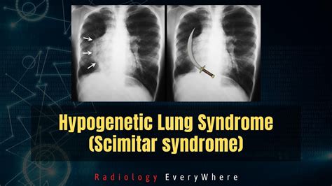 How To Diagnose Scimitar Syndrome Hypogenetic Lung Syndrome