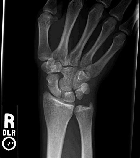 Scaphoid Fracture Mechanism Of Injury And Treatment Options Of This