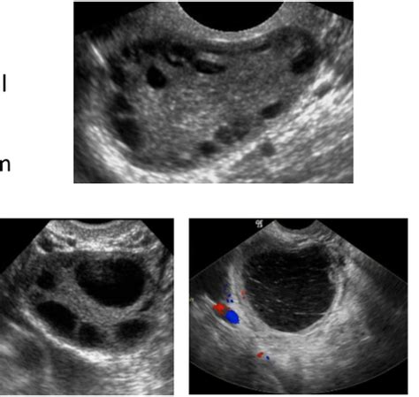 Ovarian Cysts And Benign Ovarian Pathology Flashcards Quizlet