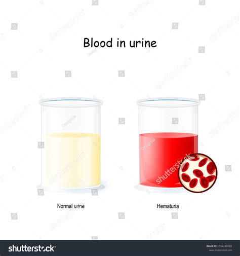 2 Bloody Cloudy Urine Stock Vectors and Vector Art | Shutterstock
