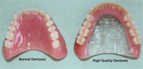 Complete Dentures - Northland Prosthodontics - Northland Denture ...