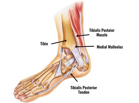 Tibialis Posterior Tendinopathy In Sport