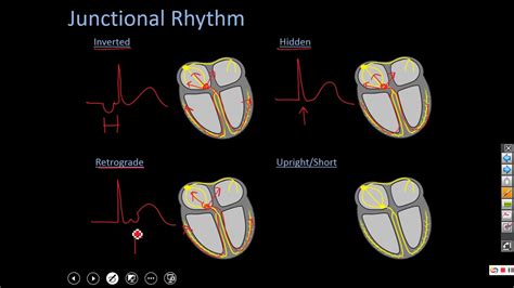 Junctional Rhythms Final Youtube