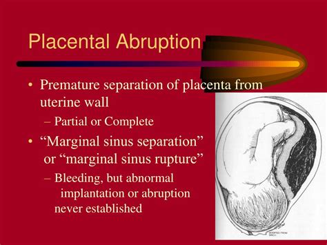 Ppt Bleeding Late In Pregnancy Powerpoint Presentation Free Download Id6049204