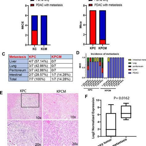 Muc16 Associated Gene Signatures In Pancreatic Cancer And Their Role In