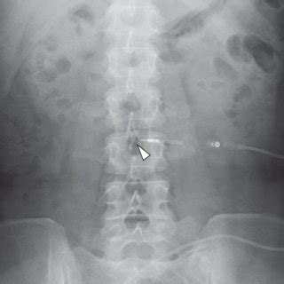 Lumbar Peritoneal Shunt Placement