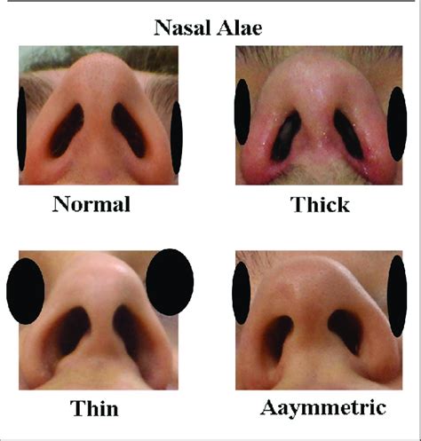 Specimens Of Nasal Alae As Normal Thick Thin And Asymmetric Cases