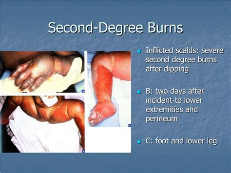 Ppt Dermatoses Resulting From Physical Factors Powerpoint