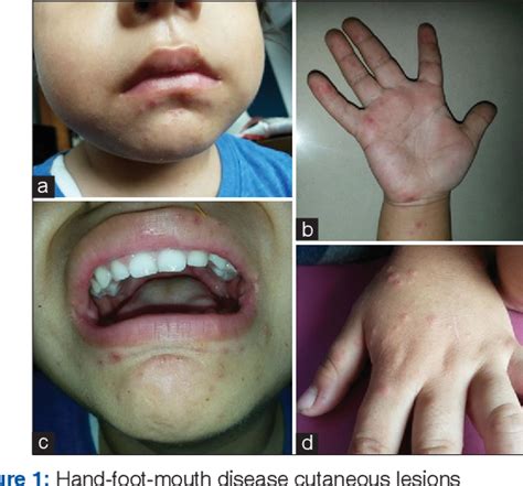 Onychomadesis Secondary To Hand Foot And Mouth Disease