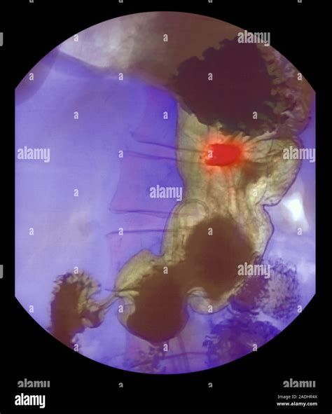 Stomach Ulcer Coloured Barium X Ray Of A Patients Stomach Brown