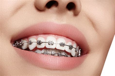 ¿cómo Se Colocan Los Brackets De Un ‘aparato Dental Vélez And Lozano