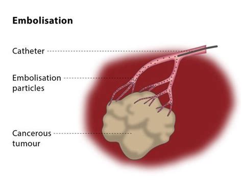 Embolisation in oncology – CIRSE